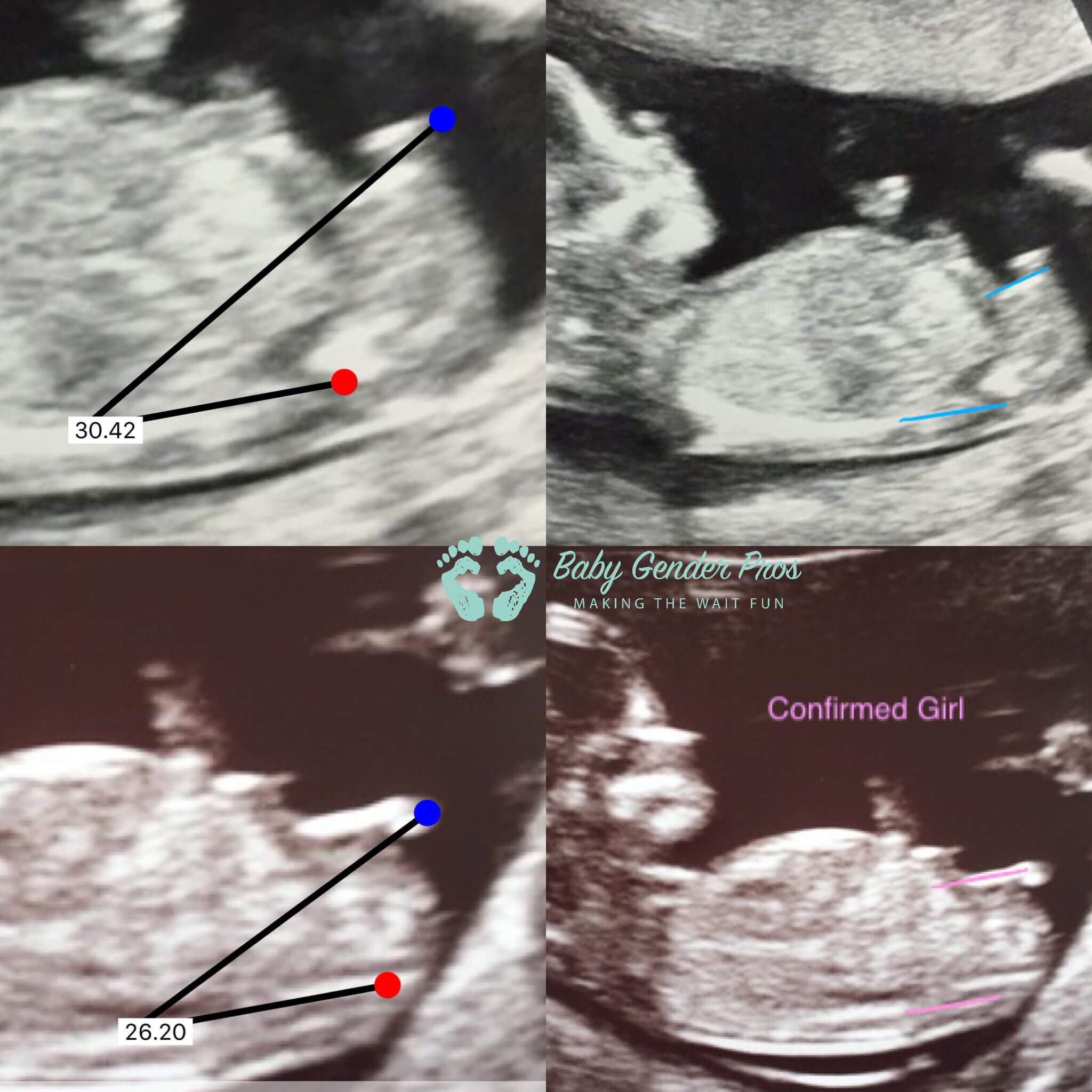 nub1 Baby Gender Pros