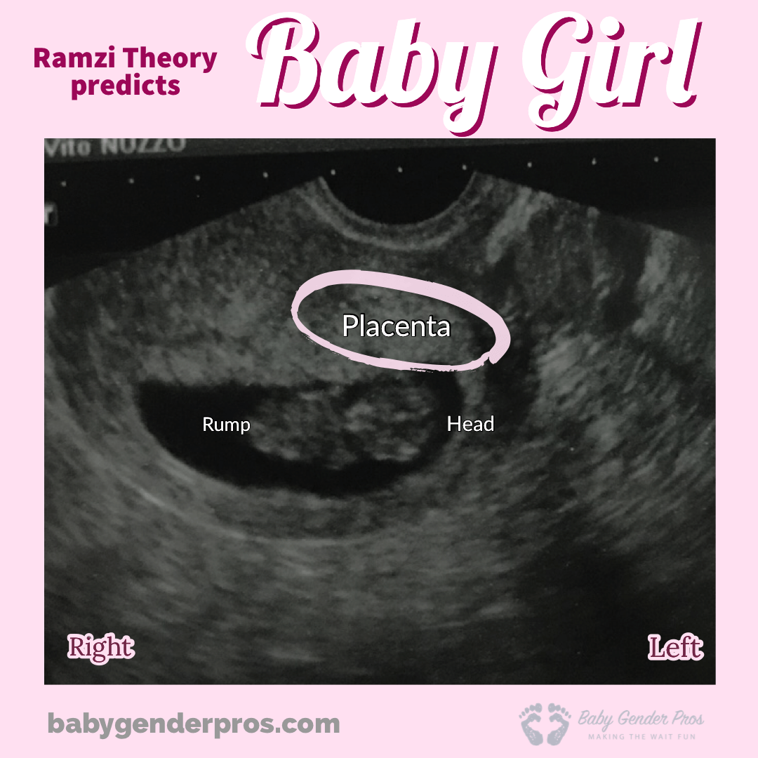 ramzi-theory-ultrasound-accurate