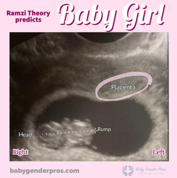 Ramzi Theory Confirmed Scans - Baby Girl Ultrasound Examples