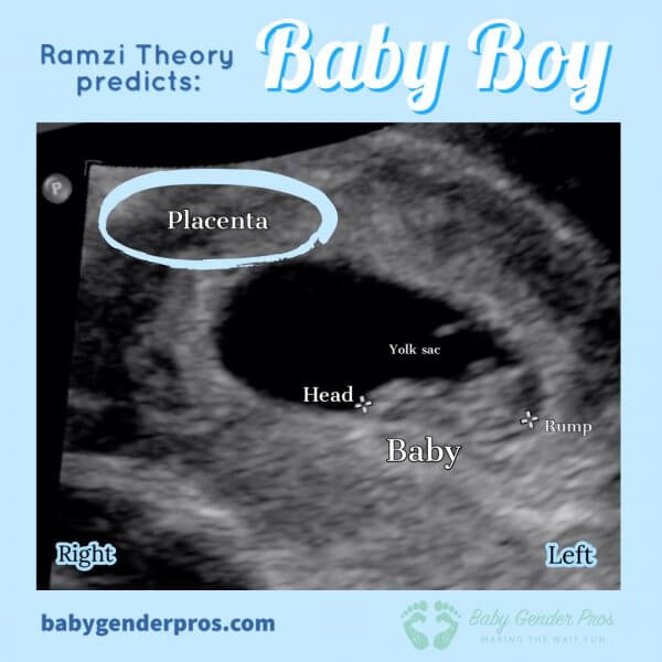 ramzi-theory-predicts-placenta-baby