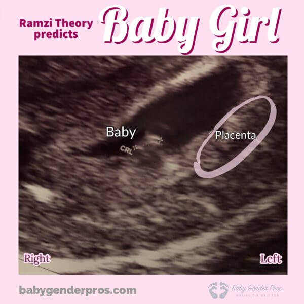 Ramzi Theory Confirmed Scans - Baby Girl Ultrasound Examples