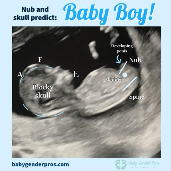 How To Tell Gender On Ultrasound At 12 Weeks