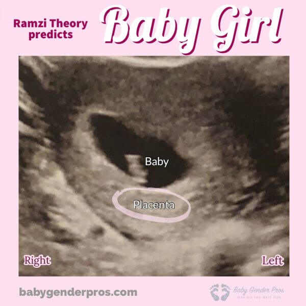 Ramzi Theory Confirmed Scans - Baby Girl Ultrasound Examples