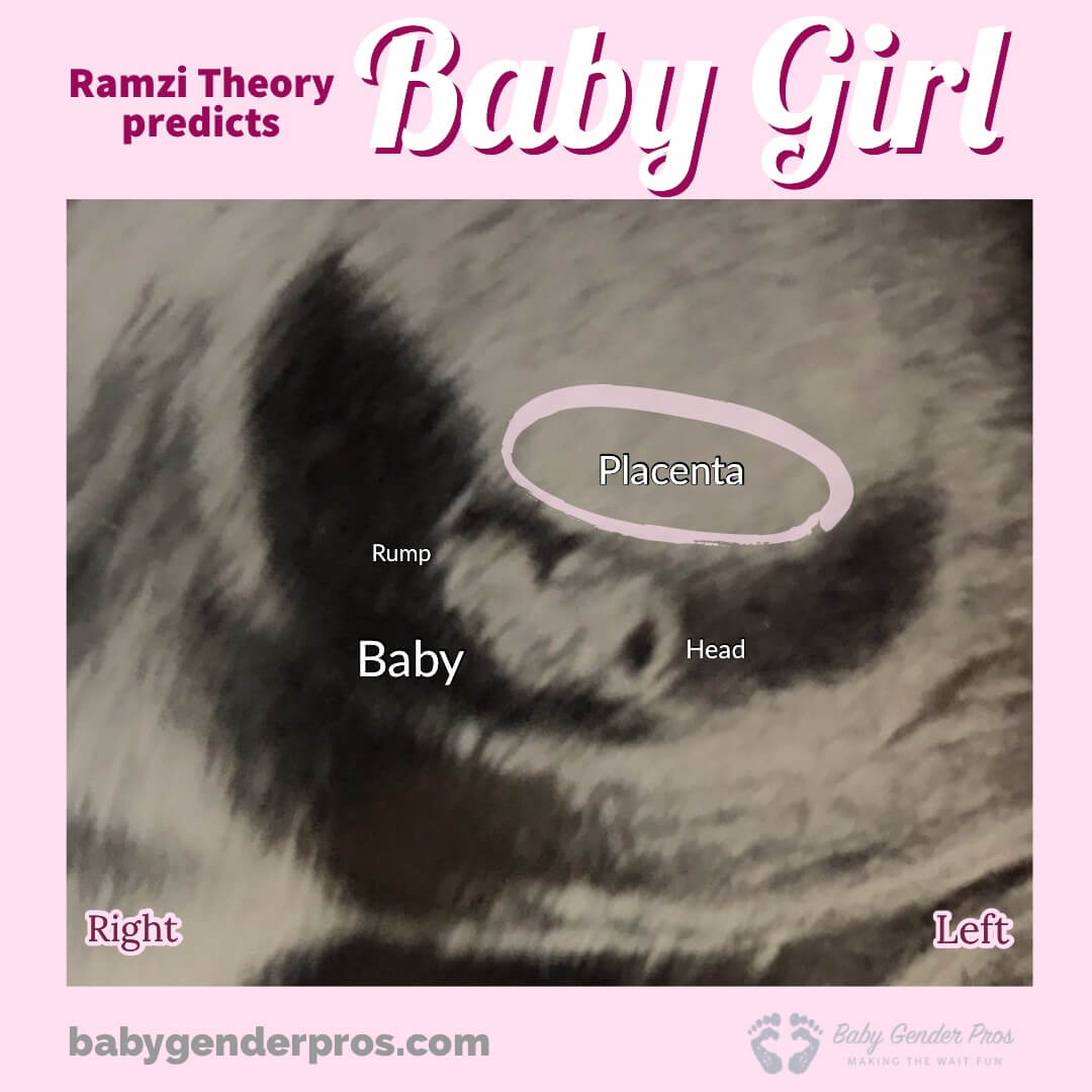 ramzi theory 8 week ultrasound