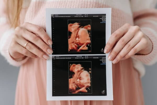 woman holding up an ultrasound representing gender prediction methods
