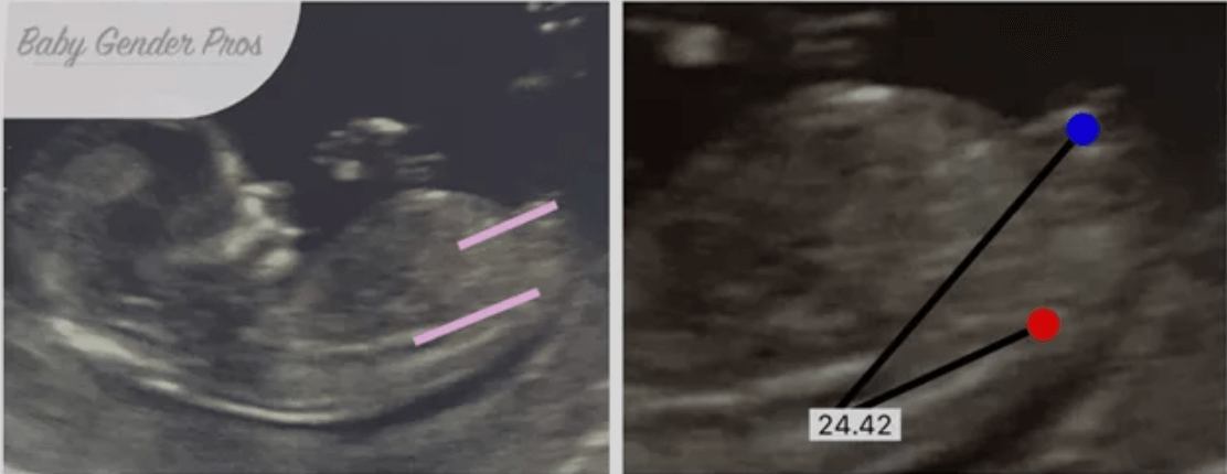 Ultrasound of baby suggesting a Male using Nub Theory Gender Prediction