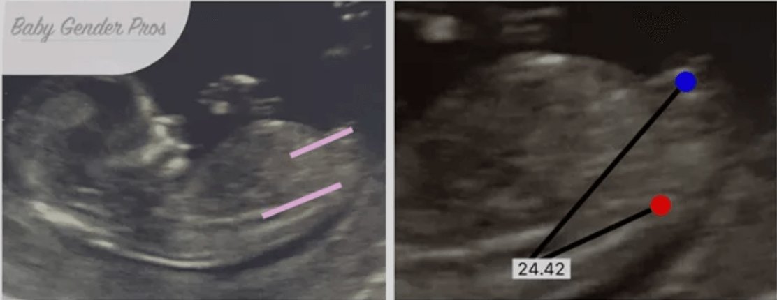 Ultrasound of baby suggesting a female using Nub Theory Gender Prediction