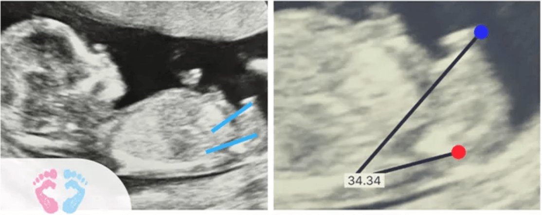 Ultrasound of baby suggesting a Male using Nub Theory Gender Prediction