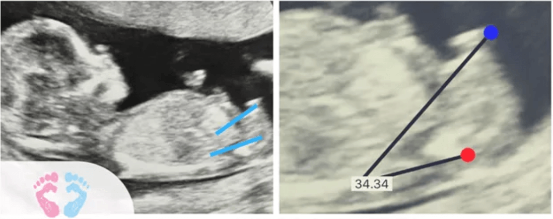 Understanding Nub Theory Ultrasound Images - Baby Gender Pros