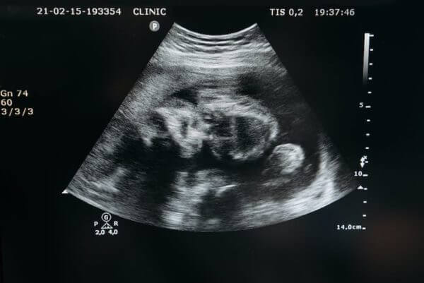 ultrasound using baby heart rate to predict gender